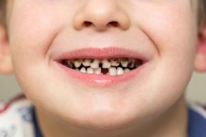 Rahasia Mencegah Gigi Berlubang pada Anak: 5 Langkah Ampuh yang Harus Diketahui!